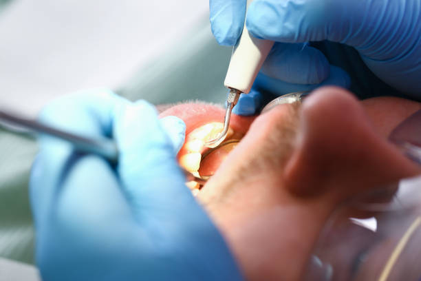 Best Emergency Treatment for Dental Infections or Abscesses in Edgewood, MD